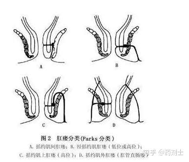 肛瘘患者能否申请残疾评定及相关条件分析