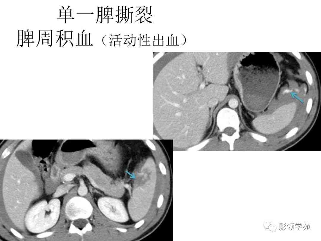 探讨肝脏血肿自然消退的可能性与条件