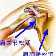 肩关节炎的治疗方法与彻底治愈可能性探讨