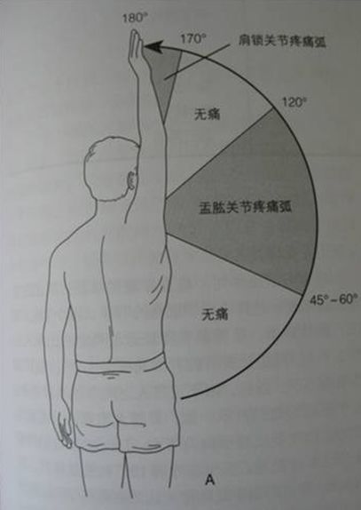 肩关节炎的严重性评估与全面治疗指南：症状、诊断、治疗及预防措