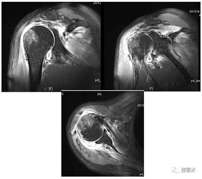 肩关节积液精准鉴别：综合解析与常见病症对比诊断要点