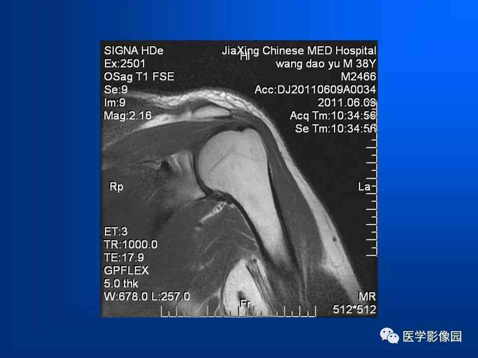 肩袖损伤可以认定工伤吗