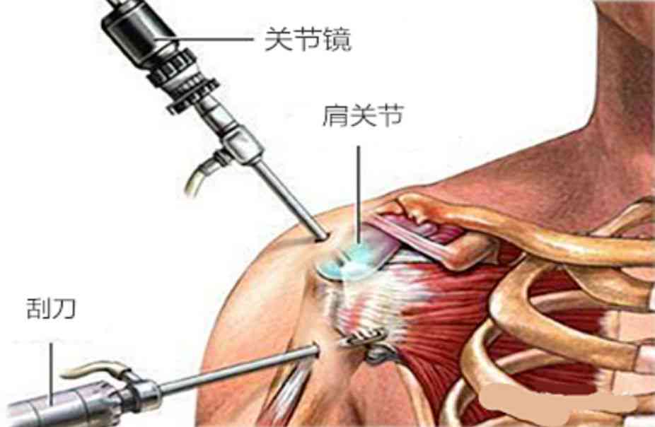 肩关节镜手术费用可以报销吗：价格及报销详情