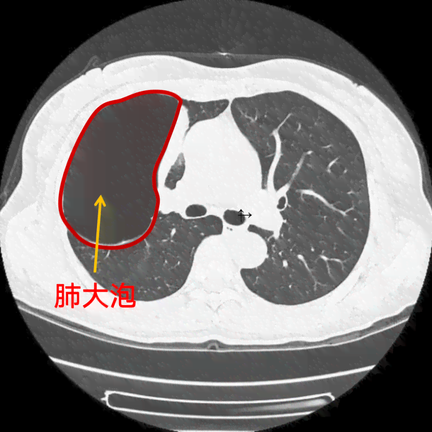 肺大泡病症是否适用于伤残等级鉴定标准探讨