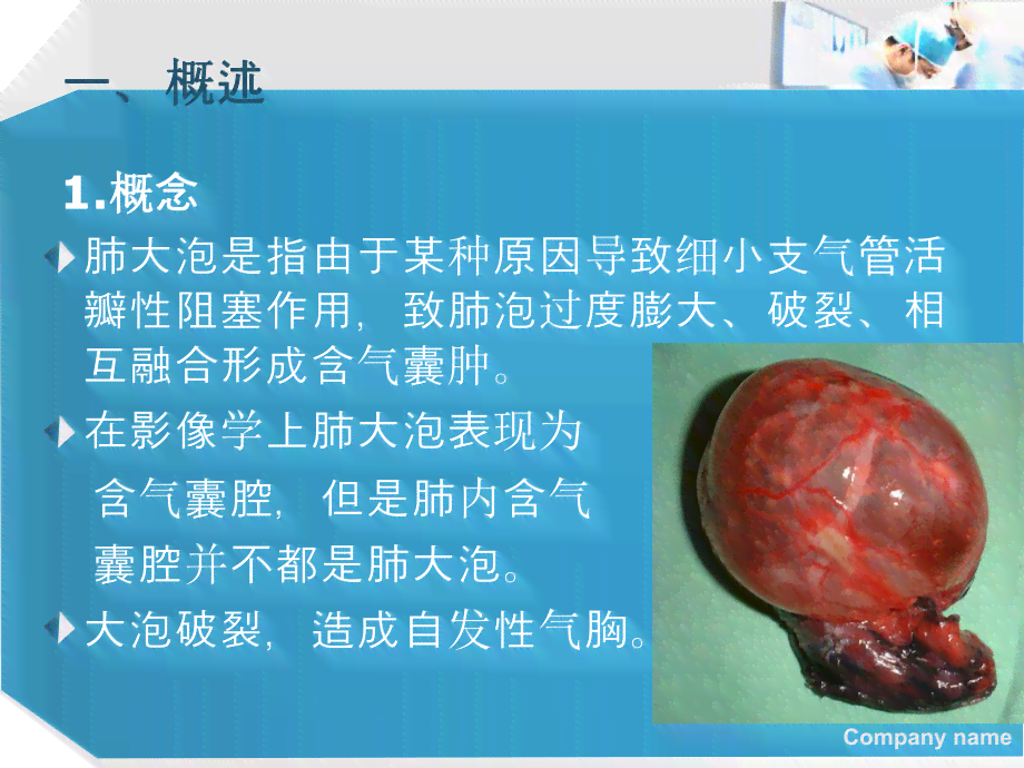 肺大泡病症是否适用于伤残等级鉴定标准探讨