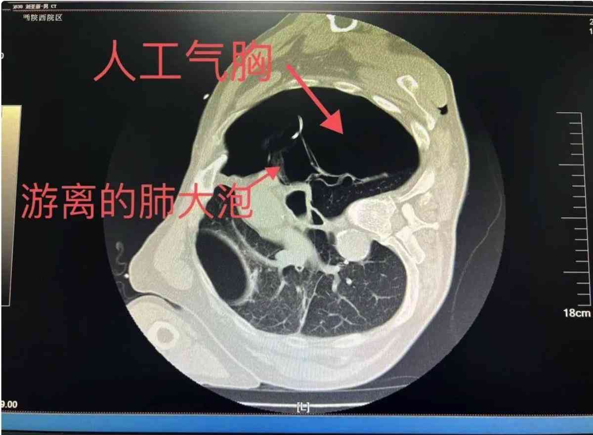 肺大泡是否属于职业病：全面解读及常见相关问题探讨