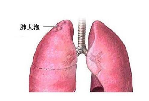 肺大泡能鉴定伤残等级吗：肺大泡伤残级别及法医鉴定标准