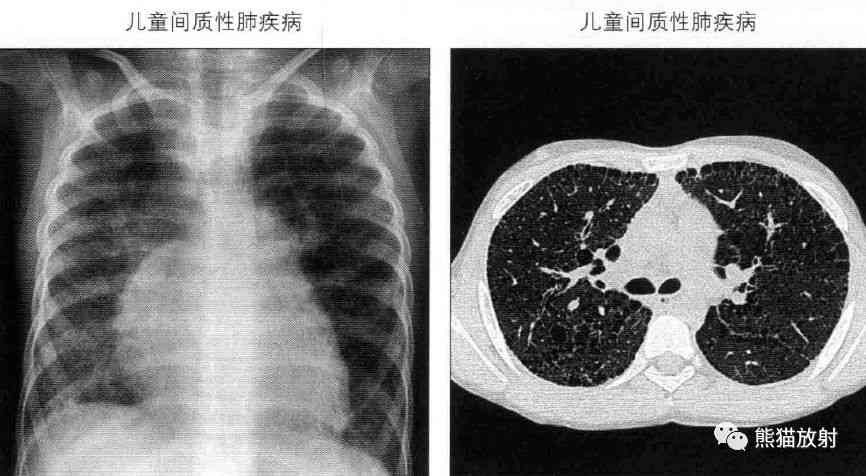 肺纤维化能评几级伤残，肺纤维化肺部纤维化伤残鉴定及评级详解