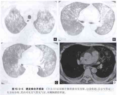 肺纤维化能评几级伤残，肺纤维化肺部纤维化伤残鉴定及评级详解