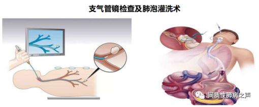 肺纤维化算职业病吗：能否申请提前退休、算残疾及重大疾病？