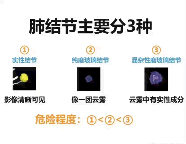 探讨肺结节是否被认定为工伤及职业病的新标准