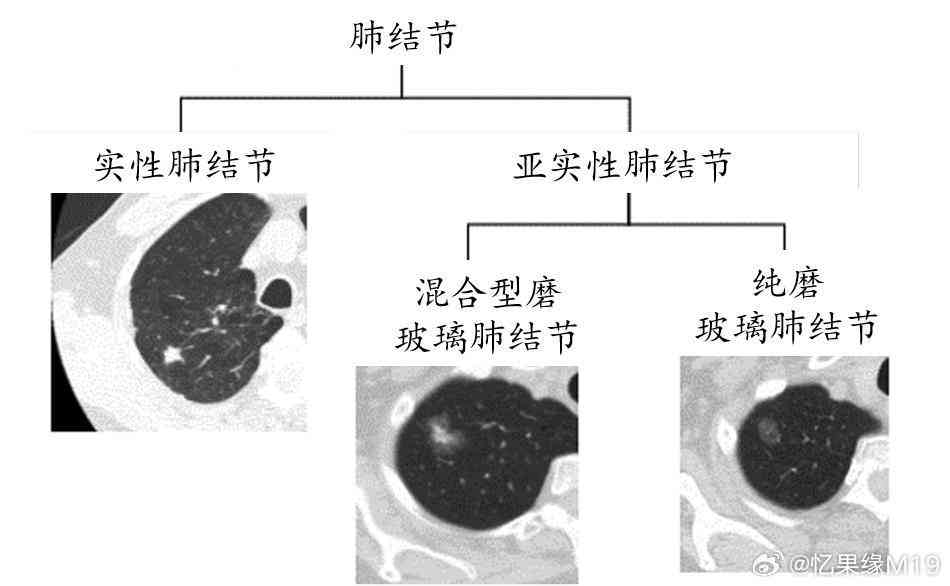 工作环境导致的肺结节：如何判定为工伤案例