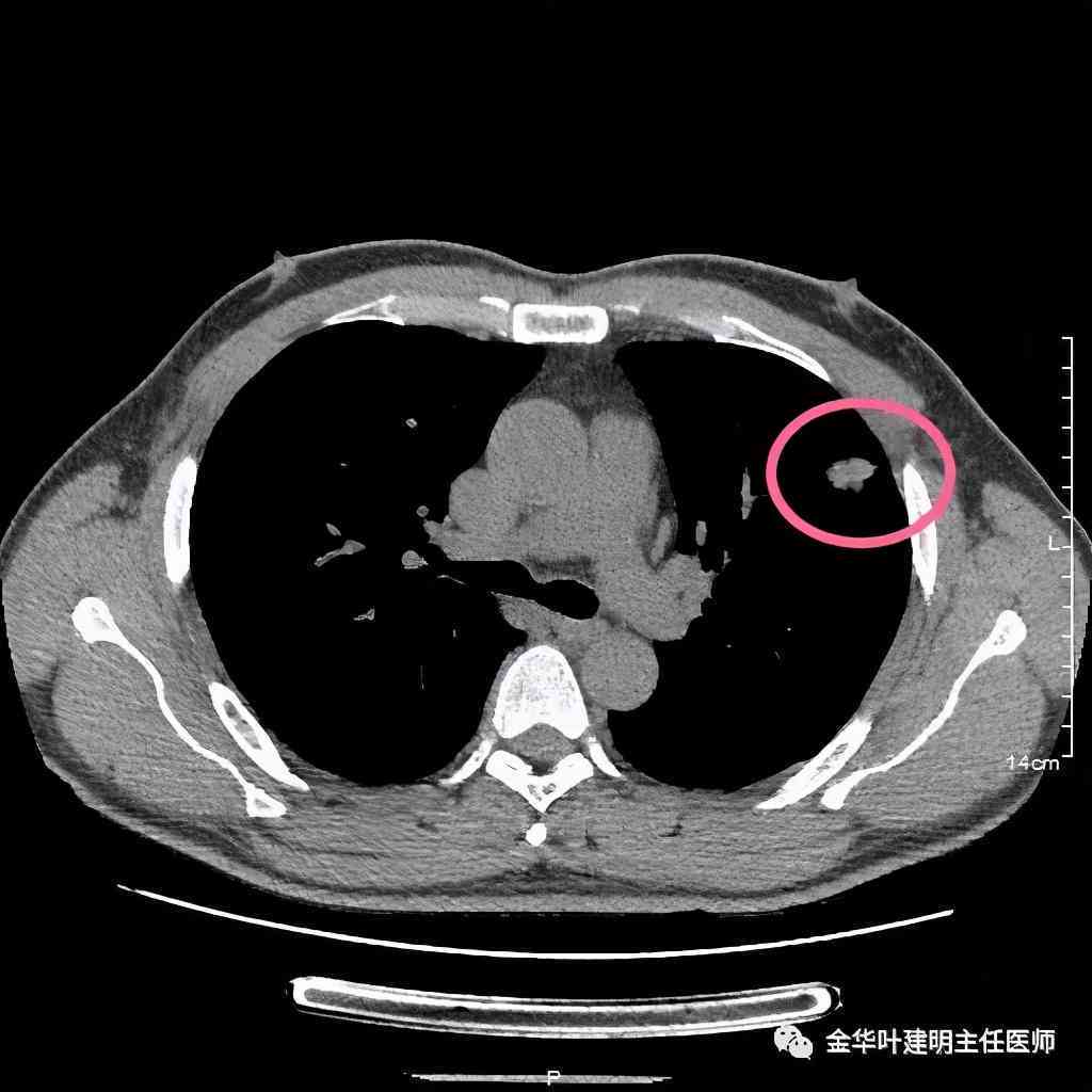 工伤认定探讨：肺结节手术是否合工伤赔偿标准