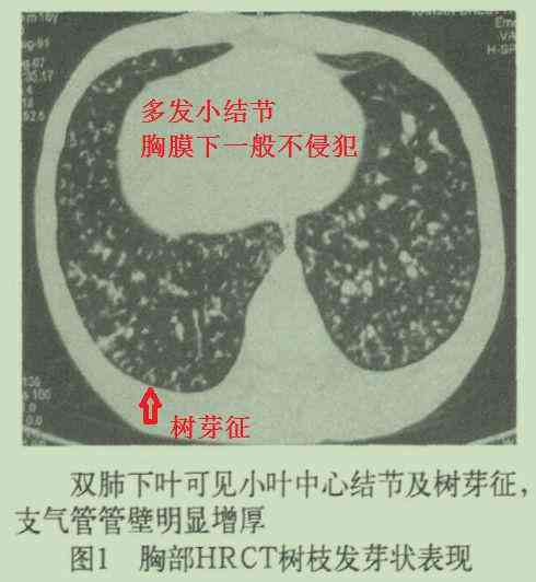肺结节是否属于工伤：全面解析职业暴露与工伤认定的关联性
