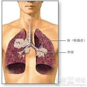 肺脓肿可以做手术吗：手术治疗的费用、必要性和治愈可能性解析