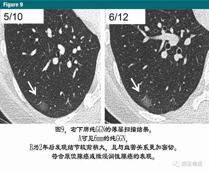 肺部感染复后入职体检标准及健指导：如何安全回归工作岗位