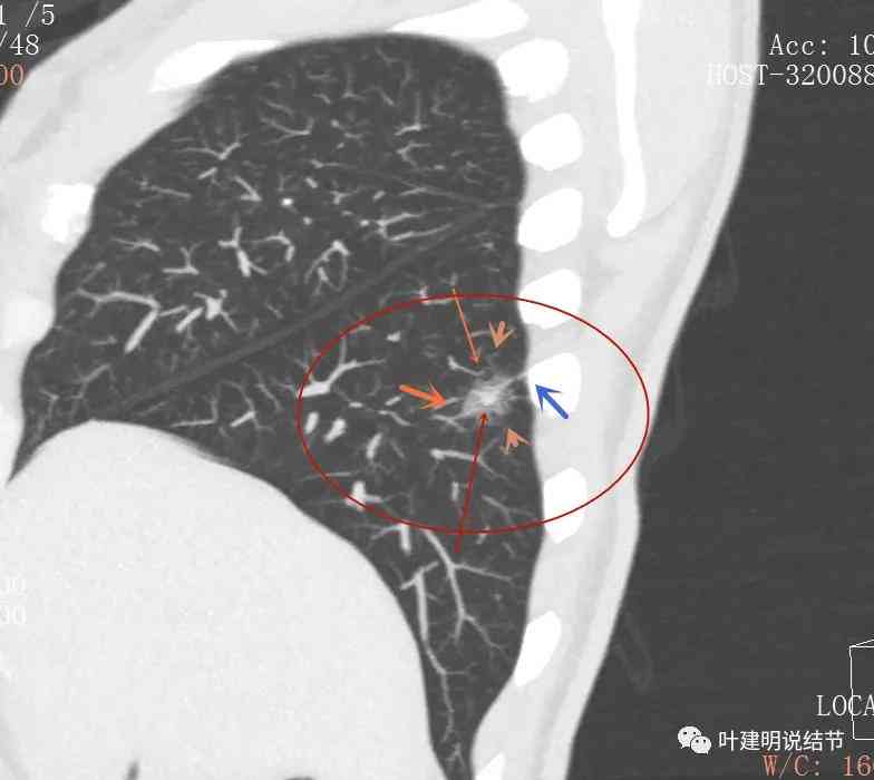 工伤鉴定：肺部结节是否合工伤申请条件