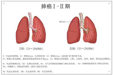 肺部肿瘤能认定工伤吗