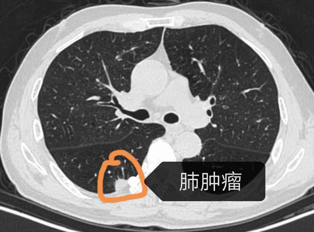 肺部肿瘤能认定工伤吗
