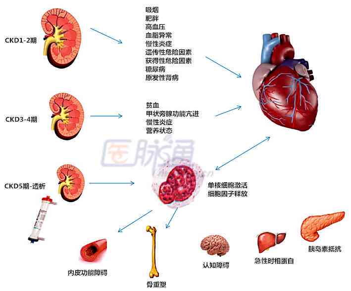 肾病综合征是否构成残疾：从医学角度解析其影响与界定