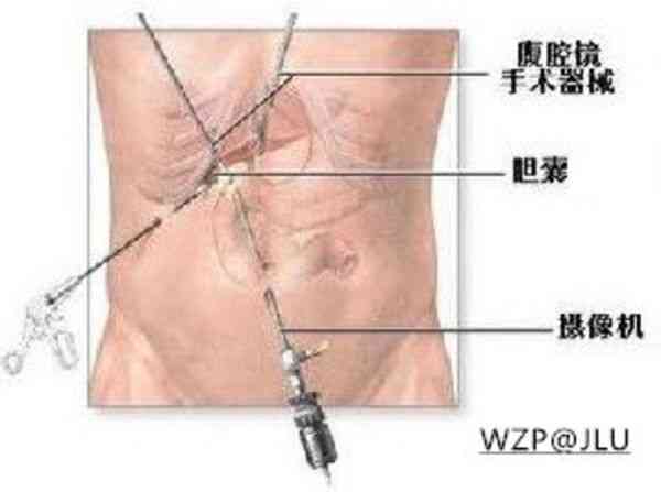 胆囊切除可以认定工伤吗