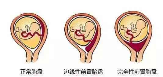 全面解读：胎盘早剥能否认定为工伤及法律相关规定探究