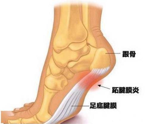 胫骨后肌肌腱炎治疗方案：治疗疼痛与复方法概述