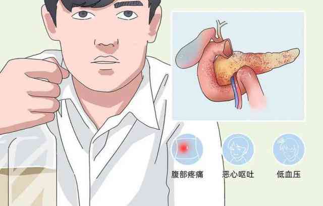 急性胰腺炎能否被认定为工伤：工伤认定标准与案例分析