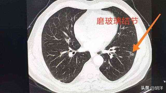 良性及局限性恶性胸膜间皮瘤：手术治疗的可能性与效果分析