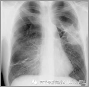 良性及局限性恶性胸膜间皮瘤：手术治疗的可能性与效果分析