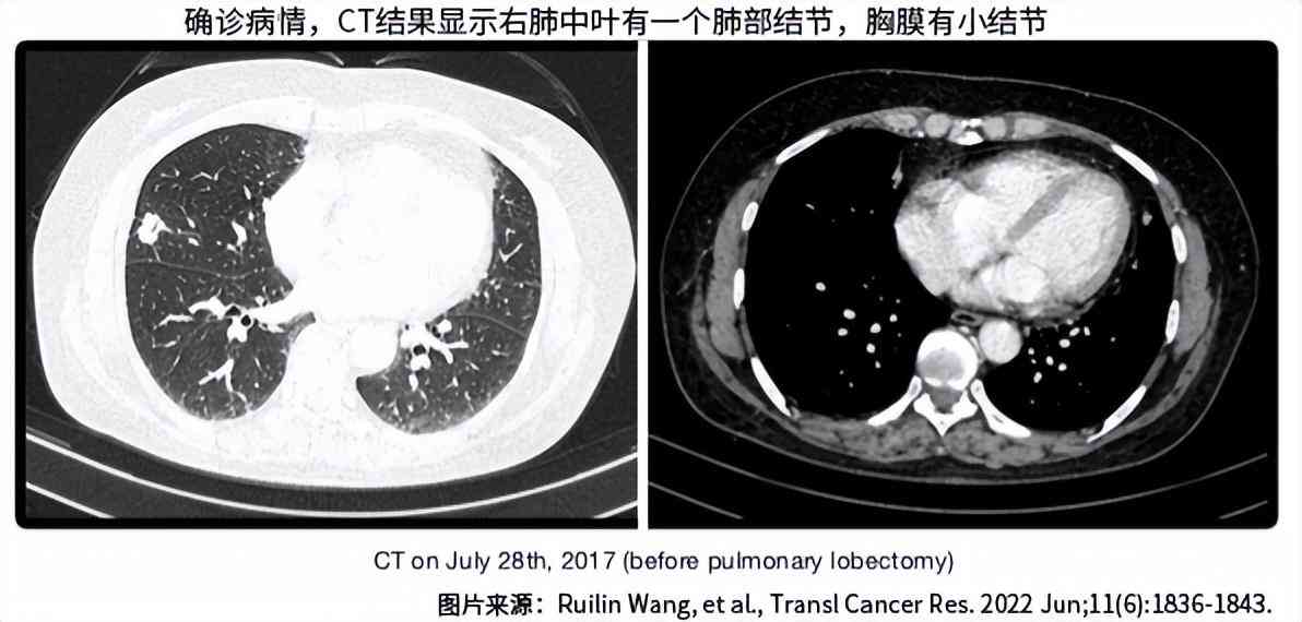 胸膜间皮瘤治好的案例：治愈经验与顶尖医生推荐