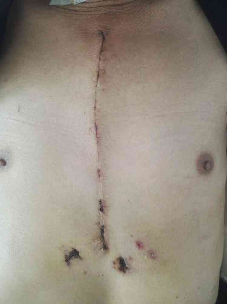 胸骨断裂自愈可能性与复过程解析