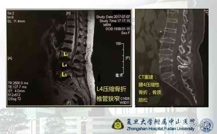 脊柱压缩性骨折工伤认定及赔偿标准详解