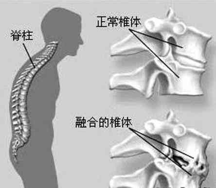 脊柱压缩性骨折：恢复过程、治疗选择与时间线解析