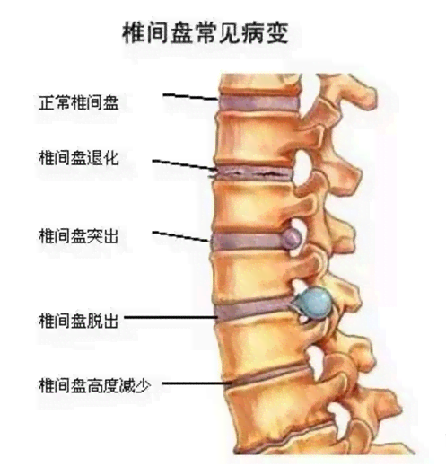 脊柱压缩性骨折：恢复过程、治疗选择与时间线解析