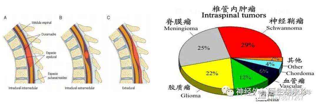 脊柱肿瘤能手术吗：治疗费用、存活期及非手术疗法探讨