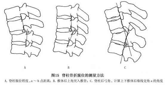 脊椎错位的伤情级别划分及其对应的健影响和治疗方案解析