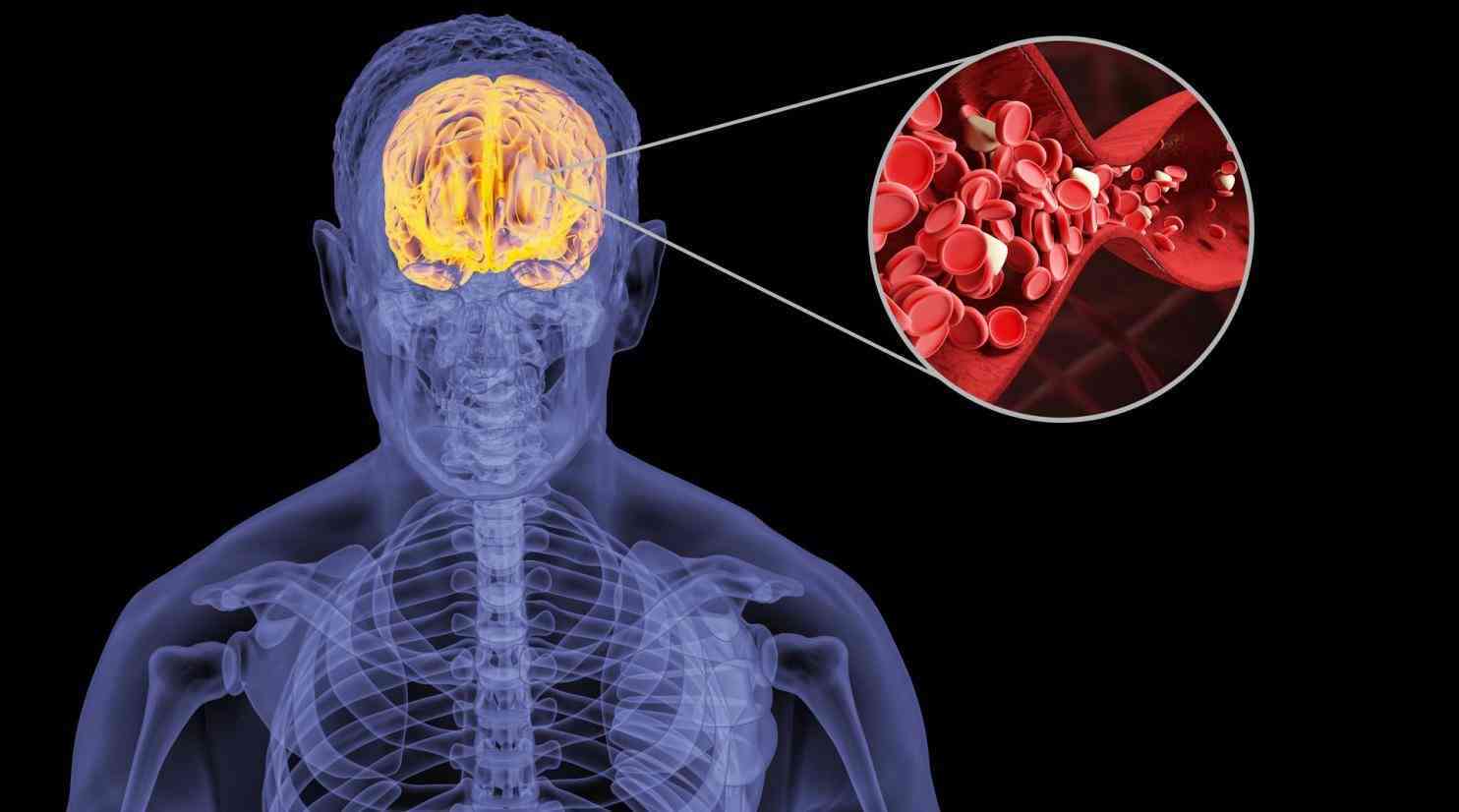 脑出血植物人怎么办：能否恢复正常、状态与症状、存活时间及受罪情况解析