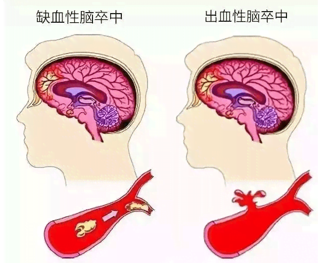 关键期限：脑出血导致的植物人状态生存期限与生活质量探讨