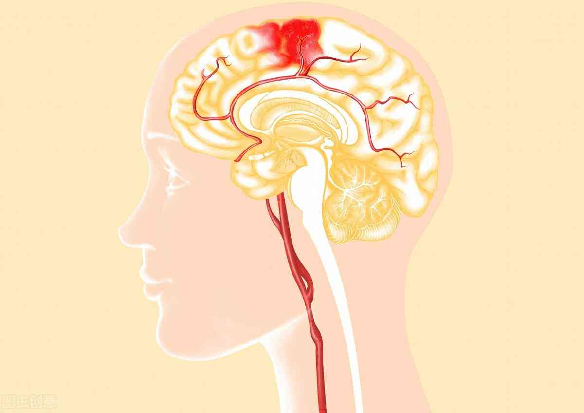 工伤脑出血赔偿标准一览：认定流程、伤残等级划分与赔偿金额详解