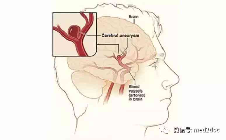 探讨脑动脉瘤破裂是否合工伤认定标准