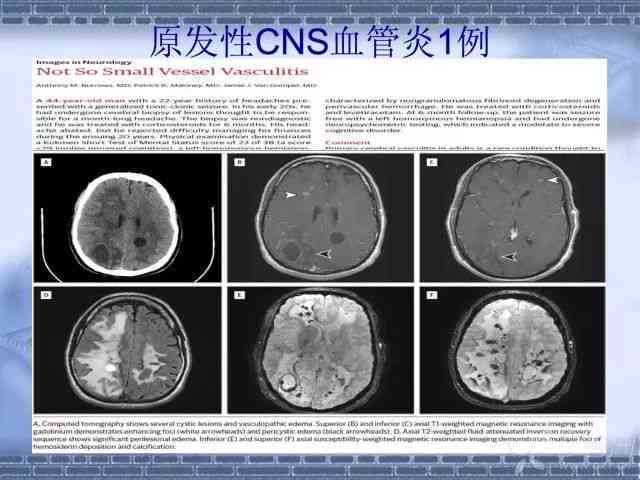 脑卒中属于脑损伤吗：探讨其严重性与是否属于颅脑损伤