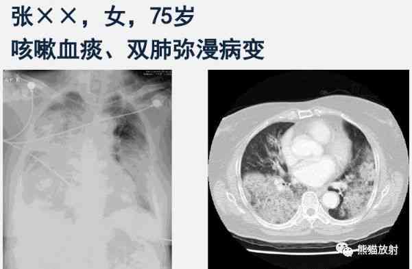 脑干出血属于职业病吗-脑干出血属于职业病吗可以做司法鉴定