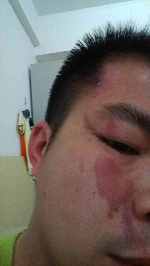脸上烧伤怎么认定工伤