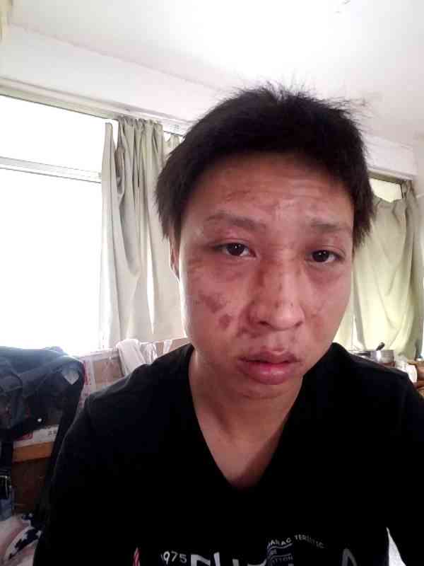 脸上烧伤怎么认定工伤