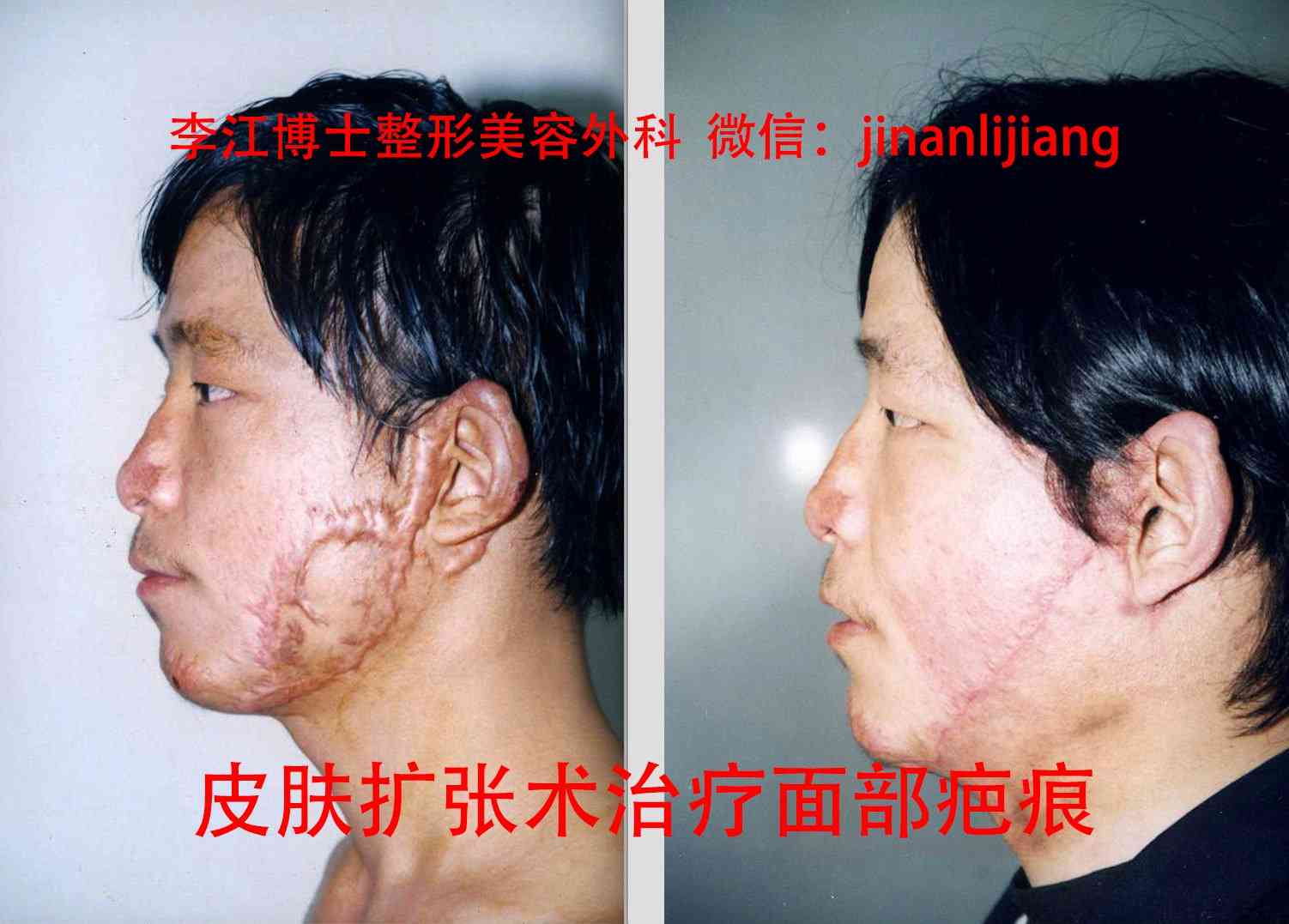 脸部有疤能认定工伤吗