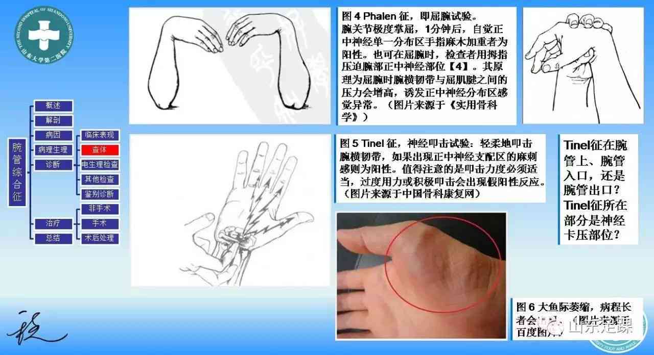 腕管综合征认定工伤
