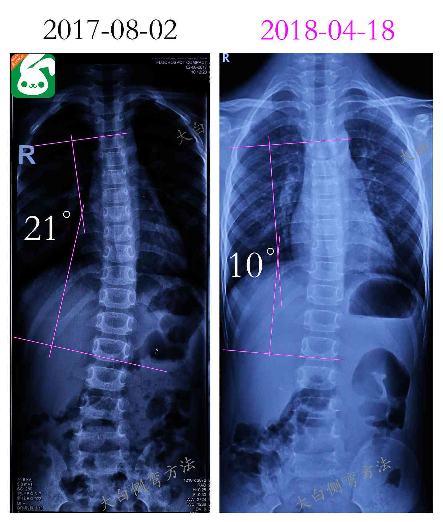腰椎侧弯可以认定工伤几级