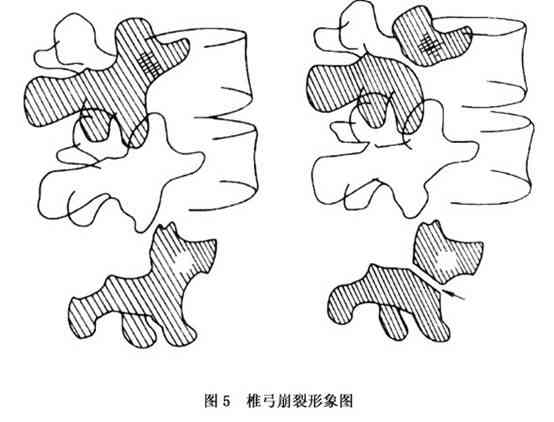 腰椎峡部裂能否认定工伤