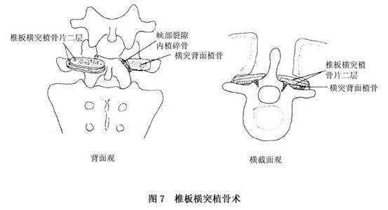 腰椎峡部裂能否认定工伤